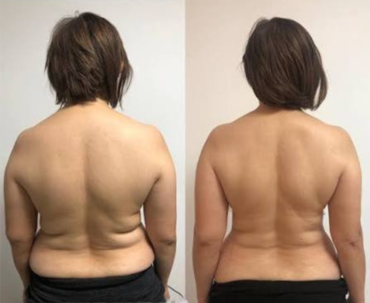 Frau 51 Jahre — Witwenbuckel und Wirbelsäulendeformation vorher/nachher