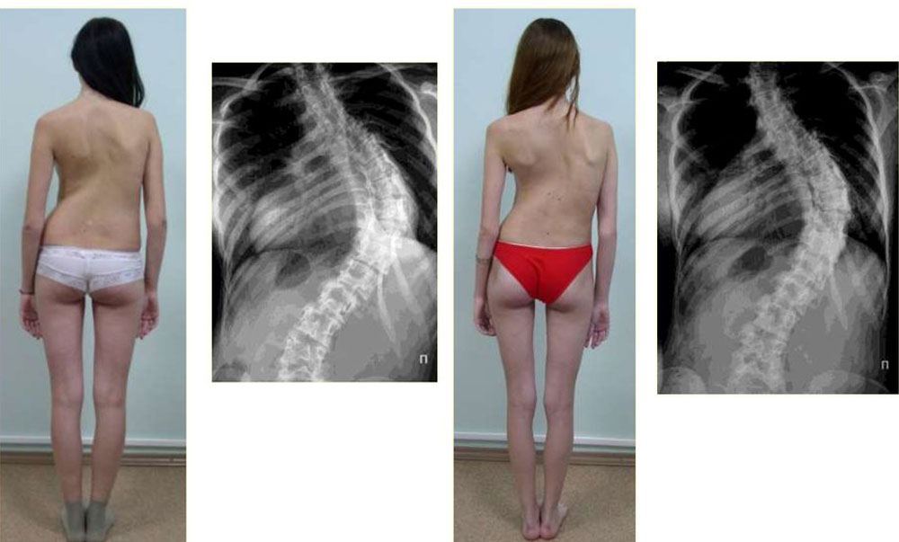 Rücken der Patientin — sichtbare Deformation